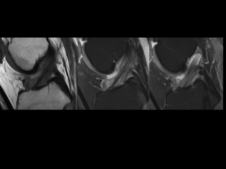 Figure 3 for case anterior cruciate ligament ( RID2781 )